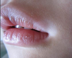 宝宝嘴唇的前期白癜风确诊办法有哪些呢