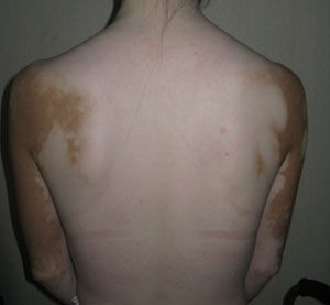 背部白癜风常见症状有哪些