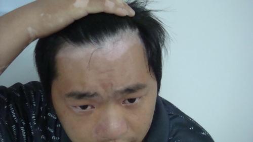 白癜风的病发对男性产生哪些危害